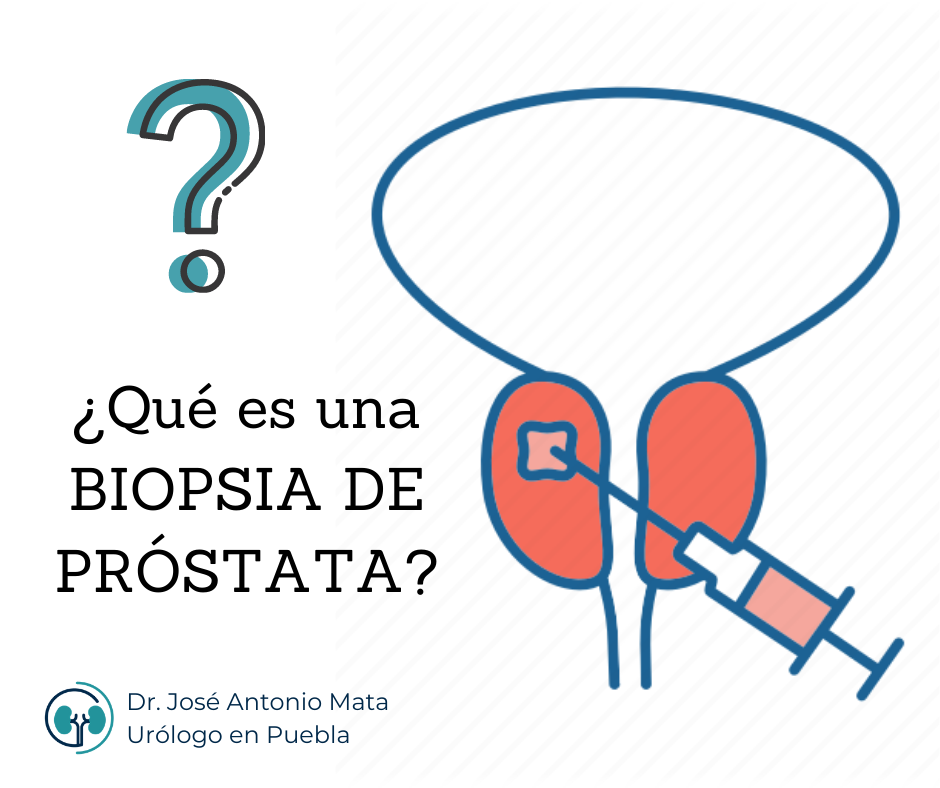 ¿qué Conoces Sobre Las Biopsias De Próstata – Urólogopuebla